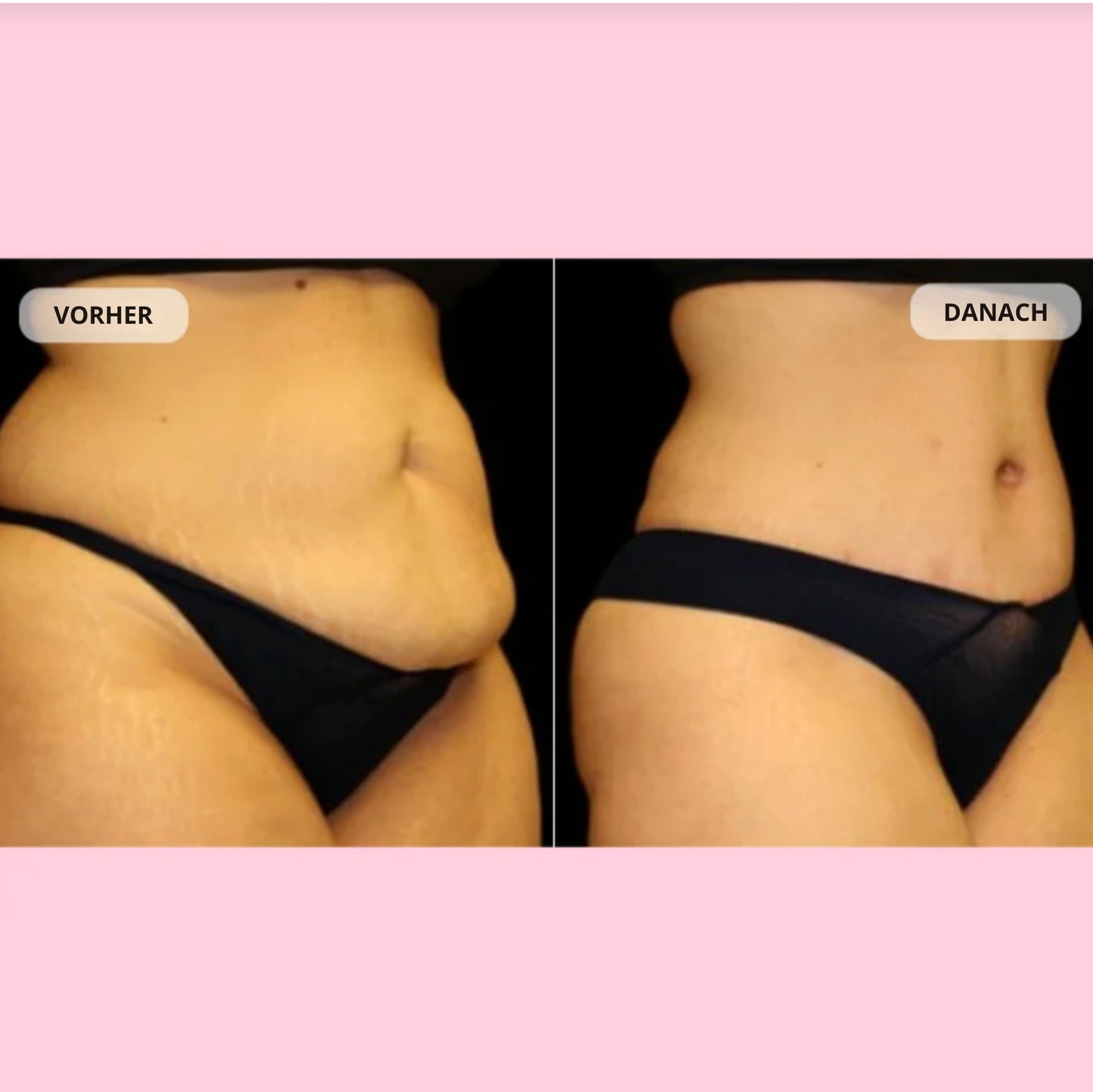 Healthierly™ Fettverbrennender Gürtel